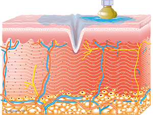 Collagen Synthesis begins | Phoenician Eye Specialists